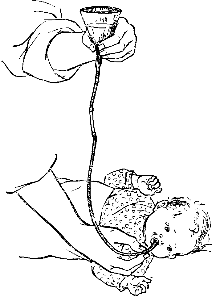 Новорожденным можно промывать. Техника зондового промывания желудка у детей. Зондовое промывание желудка у детей. Техника промывания желудка через зонд алгоритм. Техника зондового промывания желудка у детей алгоритм.