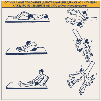 Постуральный массаж. Дренажные положения для отхождения мокроты. Дренажная гимнастика для отхождения мокроты. Постуральный дренаж и дренажную гимнастику. Позиционный (Постуральный) дренаж.