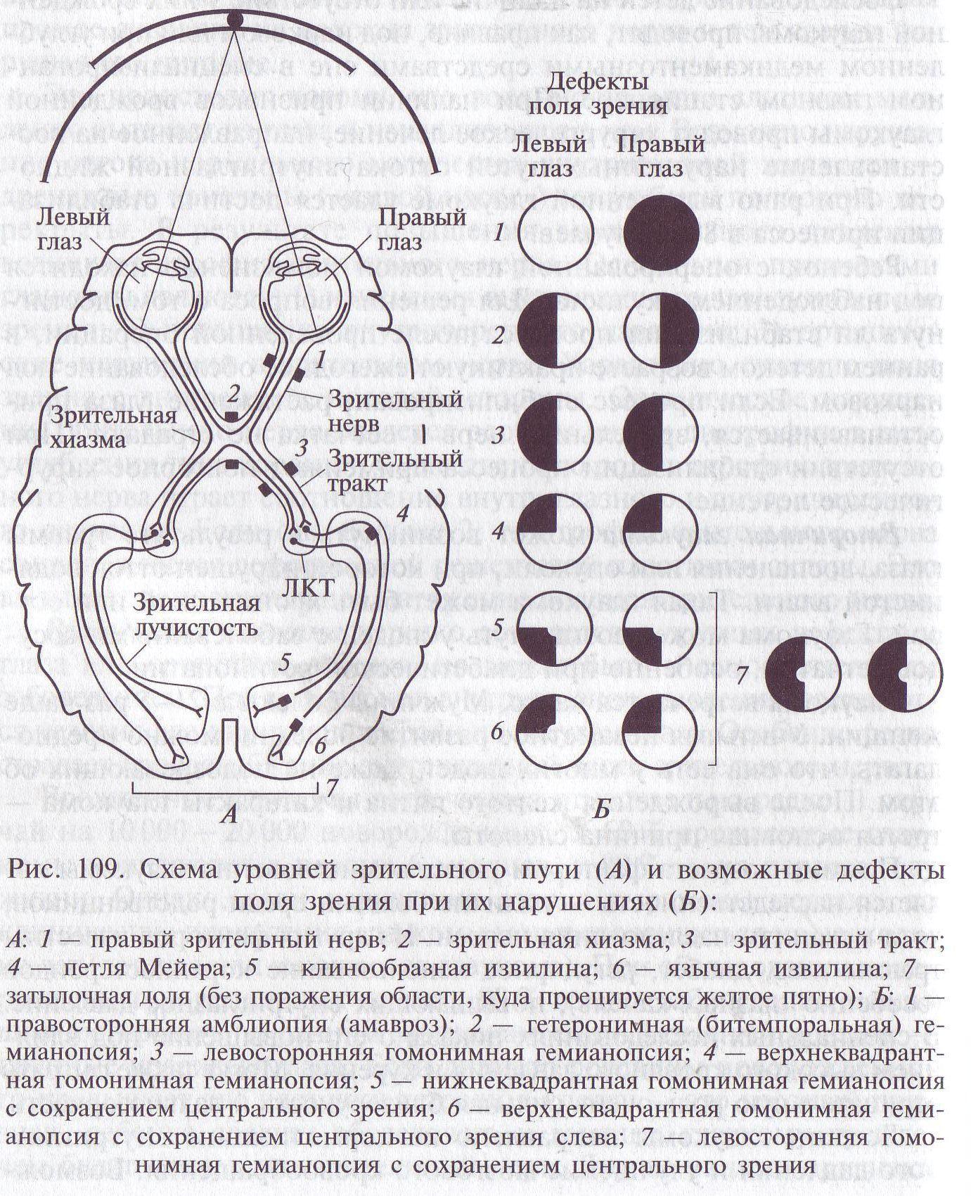 Какой глаз левый а какой правый. Ход волокон зрительного нерва. Выпадение полей зрения неврология. Зрительный нерв хиазма зрительный тракт. Выпадение полей зрения схема.