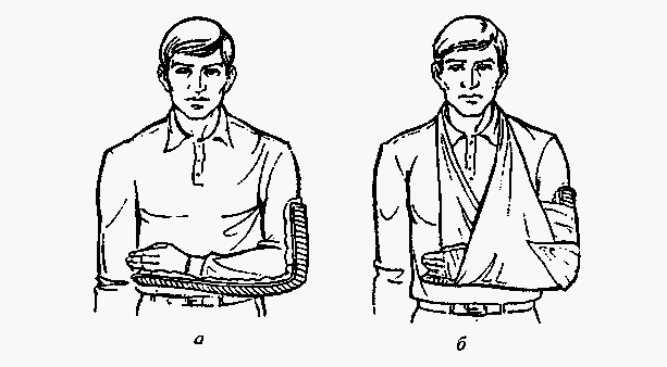 Перелом предплечья симптомы. Иммобилизация при переломе костей предплечья. Иммобилизация предплечья шиной Крамера. Транспортная иммобилизация при переломе костей предплечья алгоритм. Шина Крамера при переломе костей предплечья.