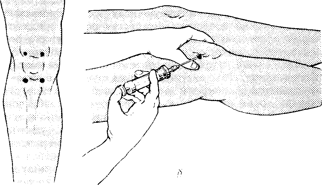 Точка колоть. Техника пункции коленного сустава топографическая. Техника пункции коленного сустава топографическая анатомия. Пункция коленного сустава топографическая анатомия. Пункция коленного сустава техника точки.