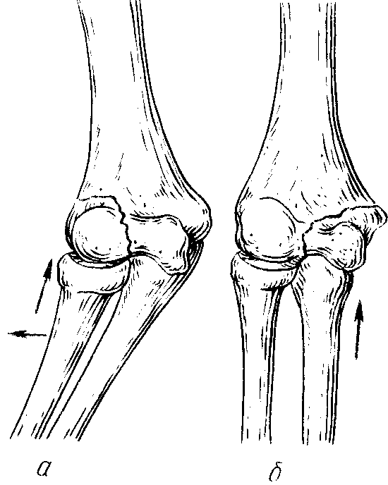 Мыщелок это кость. Межмыщелковый перелом плечевой кости. Перелом мыщелка локтевого сустава.