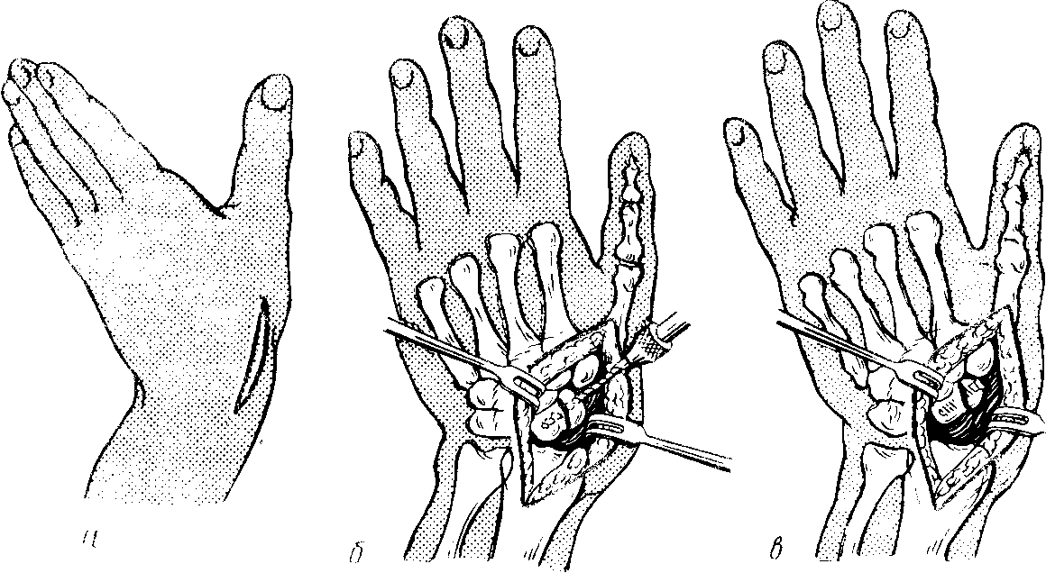 Операция на большом пальце руки