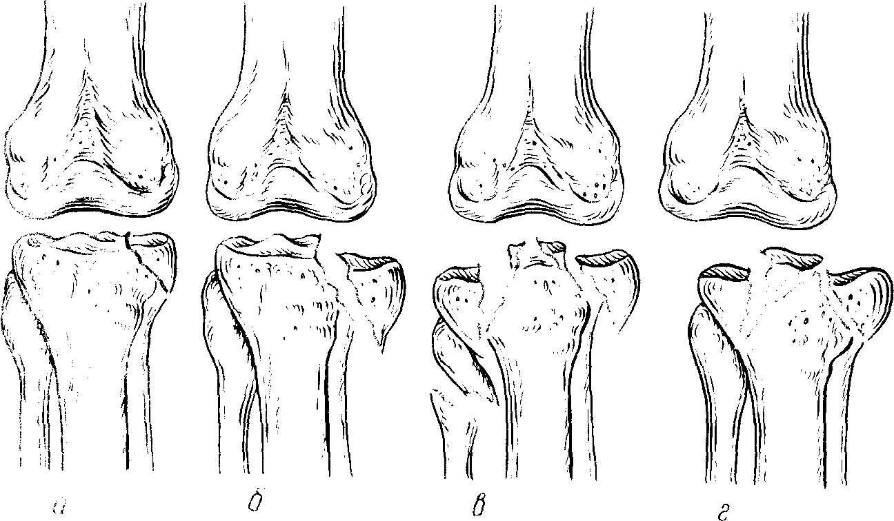 Отек медиального мыщелка. Переломы большеберцовой кости классификация. Перелом наружного мыщелка большеберцовой кости рентген.