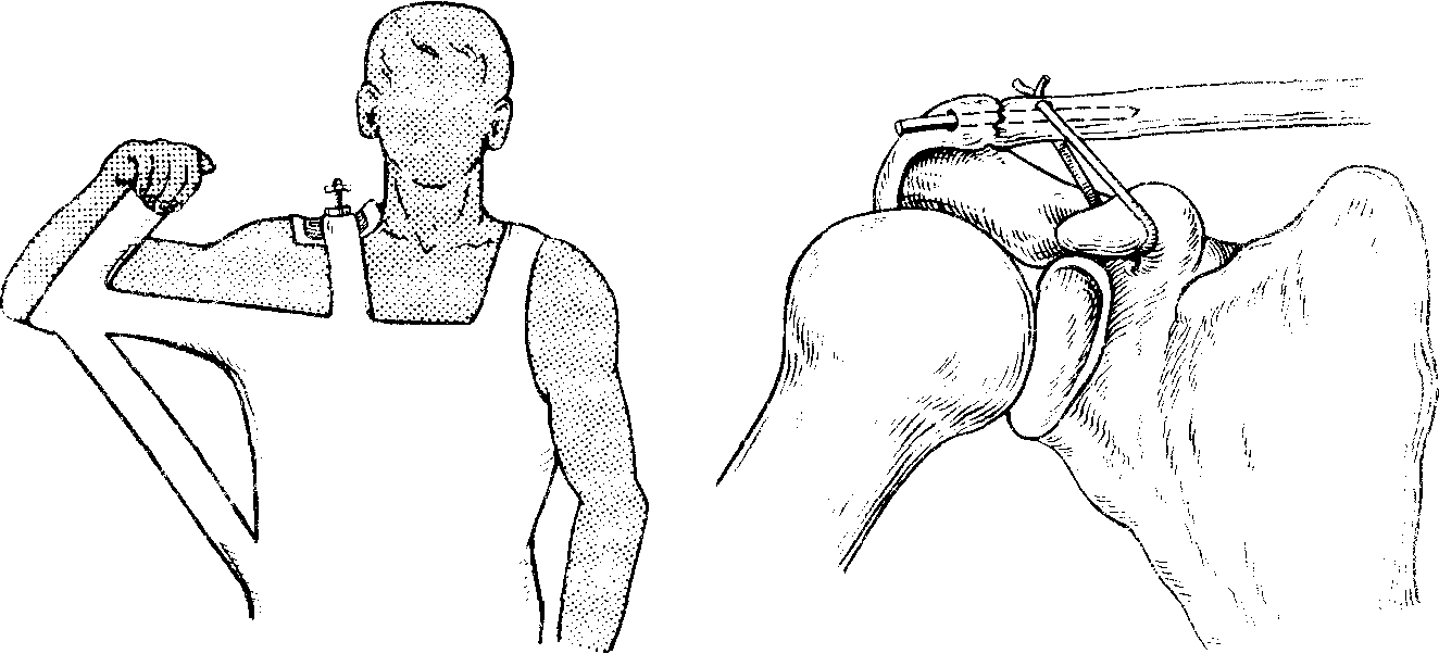 Повреждения надплечья плеча вывихи плеча