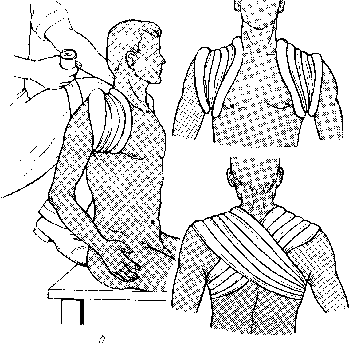 Повреждение надплечья плеча травматические вывихи плеча