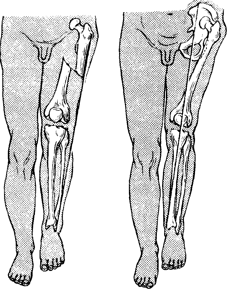 Посттравматический контрактура сустава