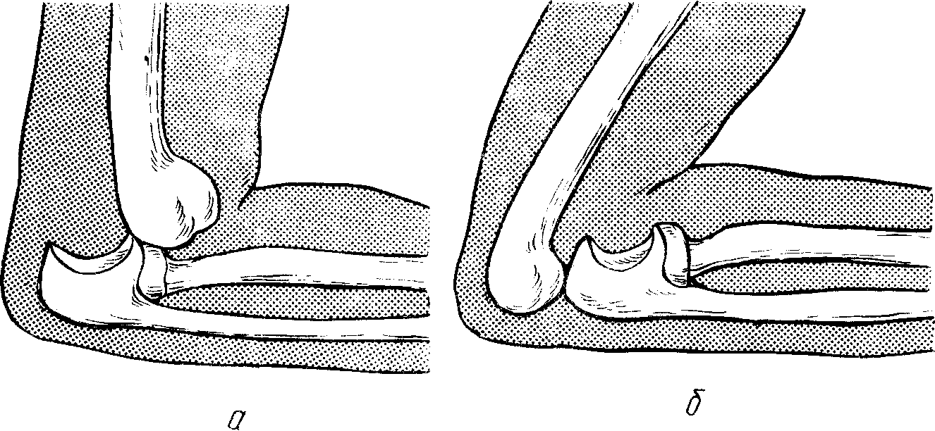 Какой вид травмы показан на рисунке. Перелом локтевого отростка рентген. Механизм травматического вывиха. Вправление вывиха локтевого сустава. Репозиция вывих голеностопного сустава.
