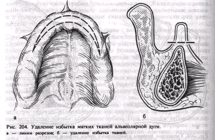 У кита альвеолярные легкие. Перелом альвеолярного отростка верхней челюсти. Альвеолярный гребень альвеолярного отростка. Слизистая оболочка альвеолярного отростка. Что такое альвеолярная дуга и отросток.
