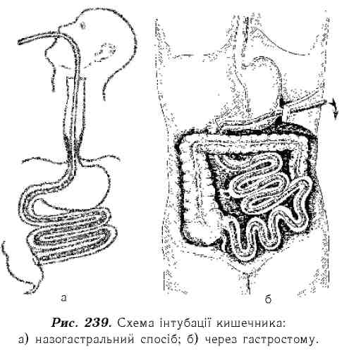 Зонд в кишечник. Схема установки гастростомы. Гастростома через кишечник.