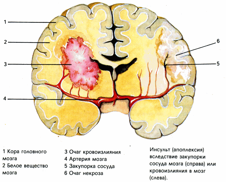 Органические изменения головного мозга. Билатеральные повреждения коры головного мозга. Повреждение структур коры головного мозга. Органическое повреждение коры головного мозга.