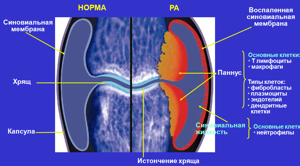 Узур при ревматоидном артрите