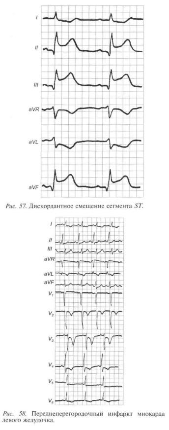 Топическая диагностика инфаркта миокарда по экг