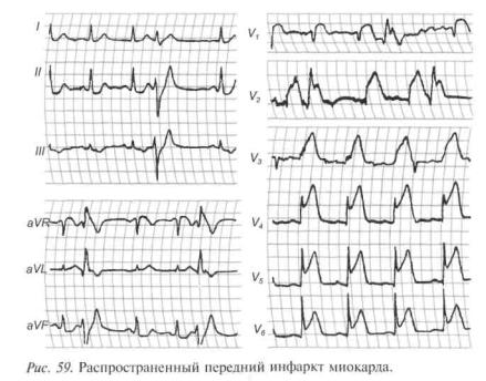 Топическая диагностика инфаркта миокарда по экг