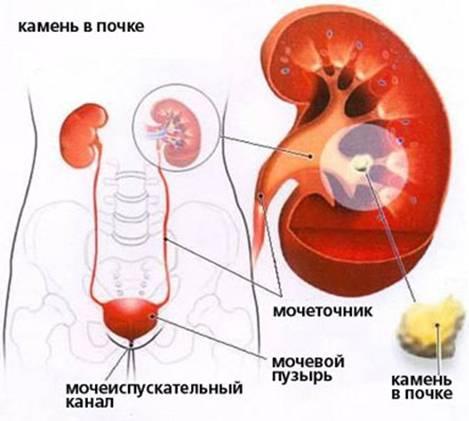 Уход за больными мочекаменной болезнью Уход за больными мочекаменной болезнью thumbnail