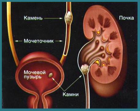 Уход за больными мочекаменной болезнью
