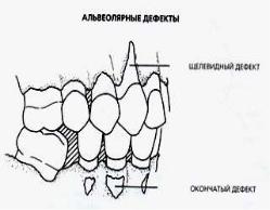 Классификация миллера. Классификация Миллера рецессии десны. Классификация Miller рецессия десны. Классы рецессии десны по Миллеру.