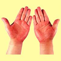 Клинические синдромы при гепатите а thumbnail