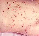 Синдромы при хроническом вирусном гепатите с