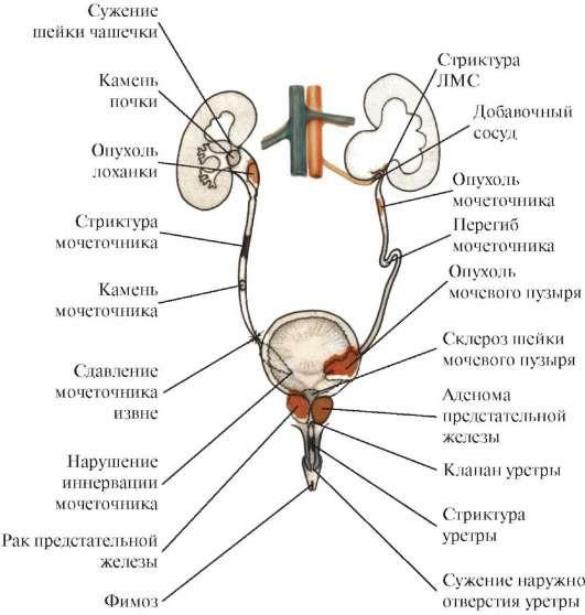 Сужение мочеиспускательного канала