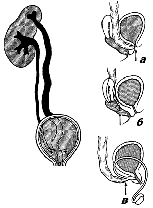 Удвоение мочеточника. Эктопия устьев мочеточников это. Эктопия отверстия мочеточника. Аномалия устья мочеточника. Внепузырная эктопия устья мочеточника.