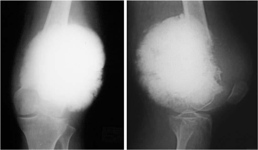 Степени саркомы. Остеосаркома бедренной кости. Остеосаркома коленного сустава рентген. Остеосаркома бедренной кости рентген.