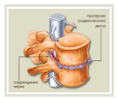 Патогенез остеохондроз поясничного отдела позвоночника