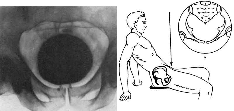 Задняя поверхность мочевого пузыря у мужчин прилежит. Рентгенограмма мочевого пузыря. Контрастная рентгенография мочевого пузыря. Проекция мочевого пузыря. Рентген мочевого пузыря у мужчин.