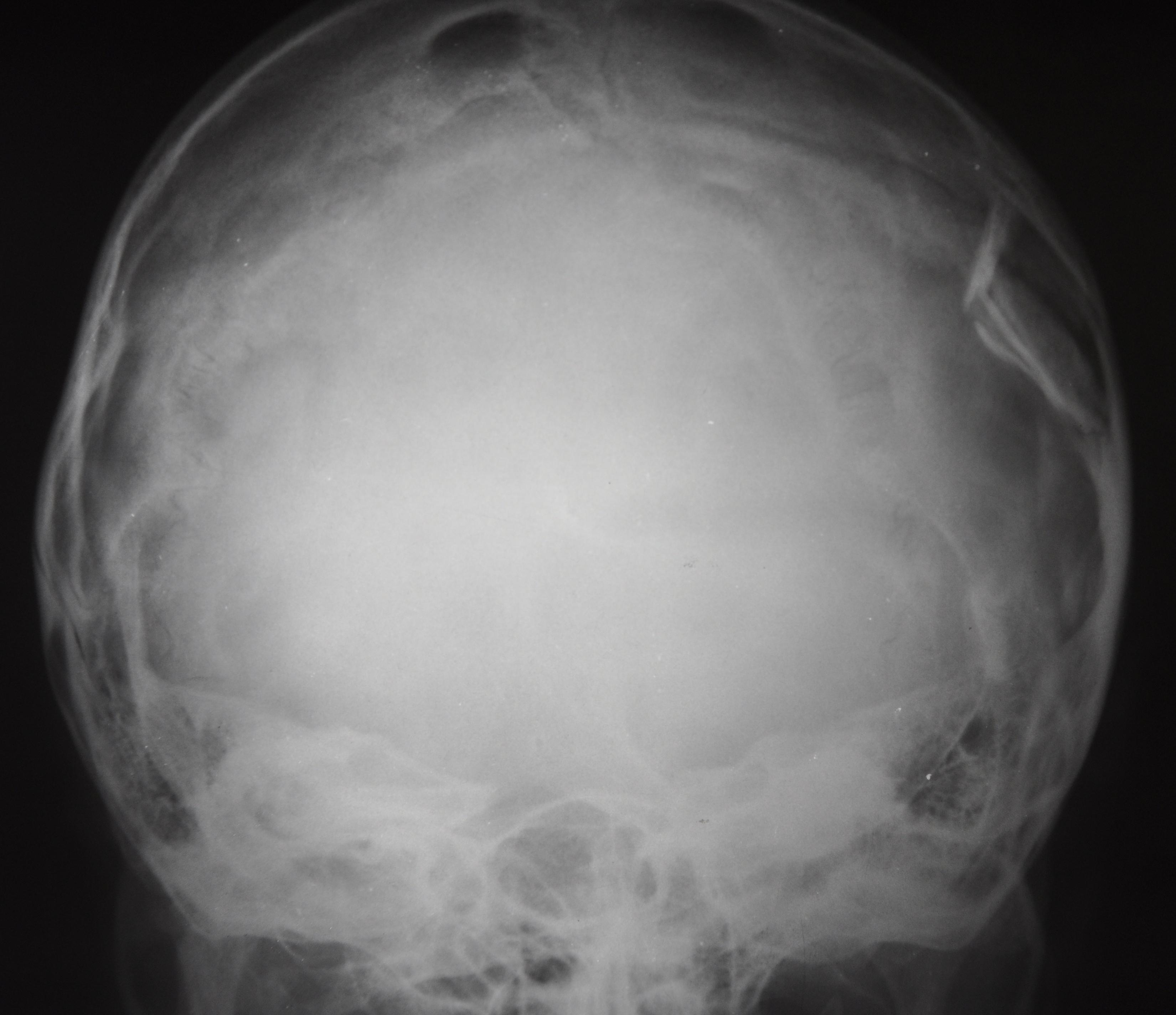 Перелом основания свода. Оскольчатый перелом черепа рентген. Перелом теменной кости черепа рентген. Вдавленный перелом костей черепа рентген. Вдавленный перелом теменной кости рентген.