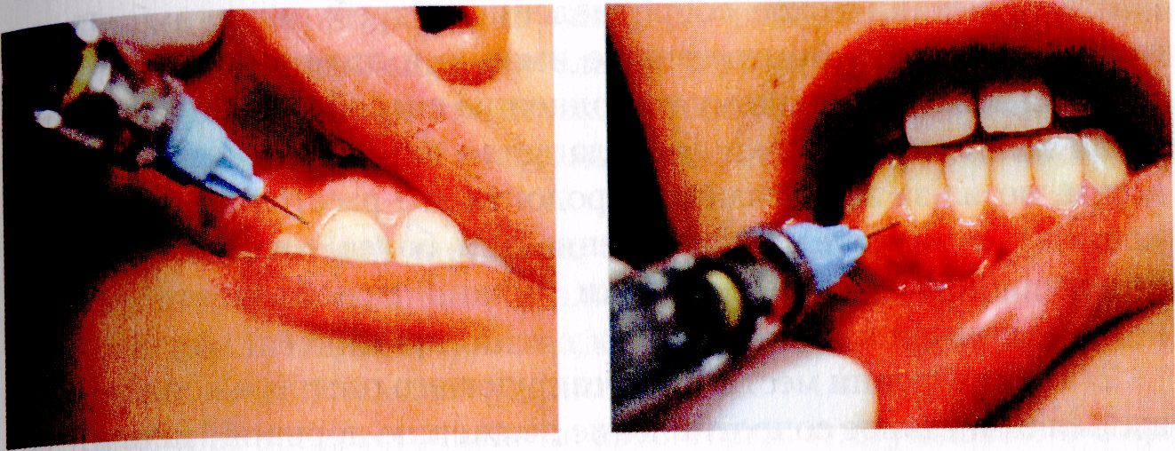 Обезболивающие при лечении зубов