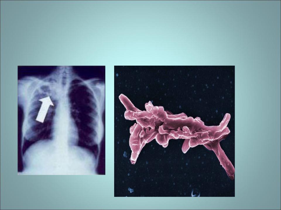Туберкулез ауруы презентация