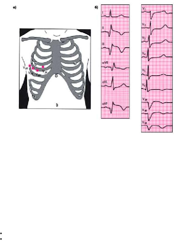 Правые грудные. V5 v6 ЭКГ стенка. V3r v4r ЭКГ. Отведения v4 v5 v6. Отведения v3 v4 на ЭКГ.