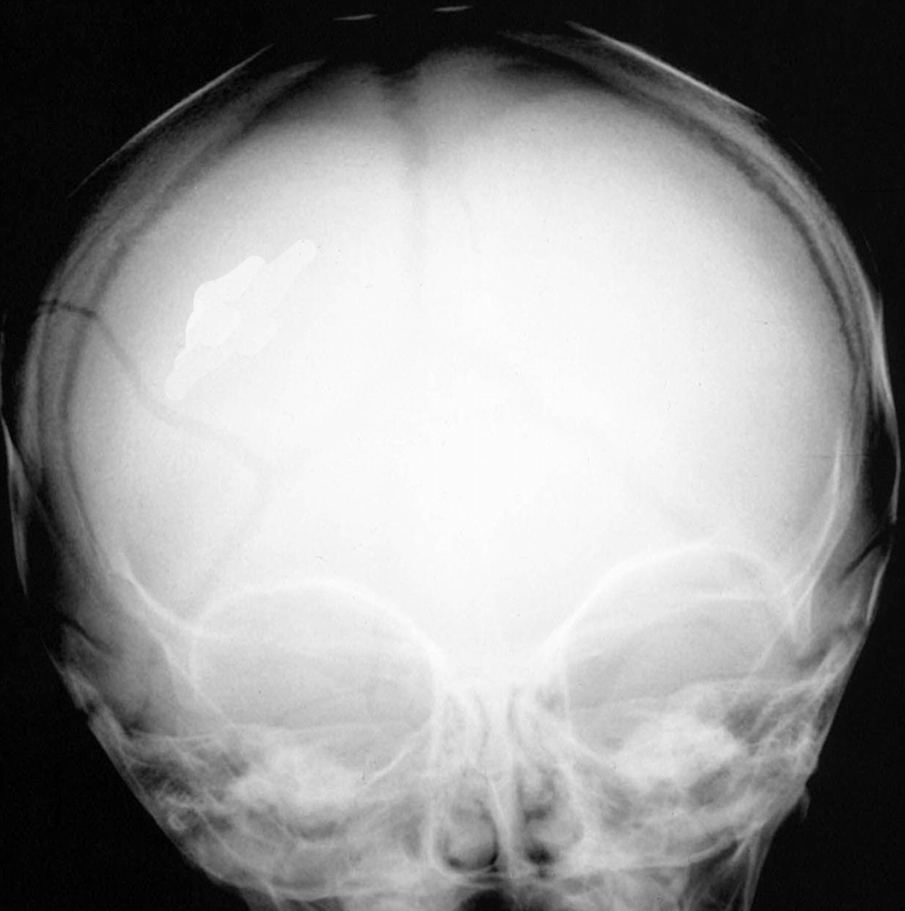 Трещина черепа у ребенка. Вдавленный перелом костей черепа рентген. Оскольчатый перелом черепа рентген. Перелом теменной кости у грудничка. Вдавленный перелом костей свода черепа рентген.