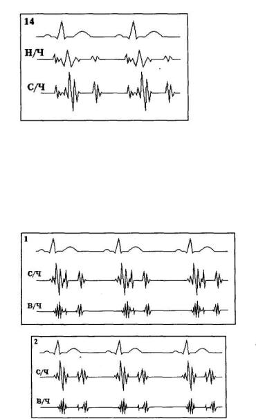 Fájdalom a szívben, a kardiogram jó. Mit fog mutatni a szív EKG? A betegség jelei