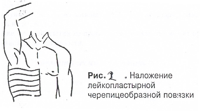 Техника наложения окклюзионной Техника наложения окклюзионной