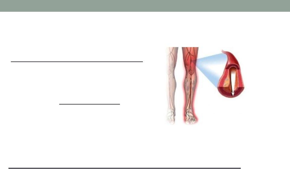 Облитерирующий атеросклероз нижних конечностей артерий pdf