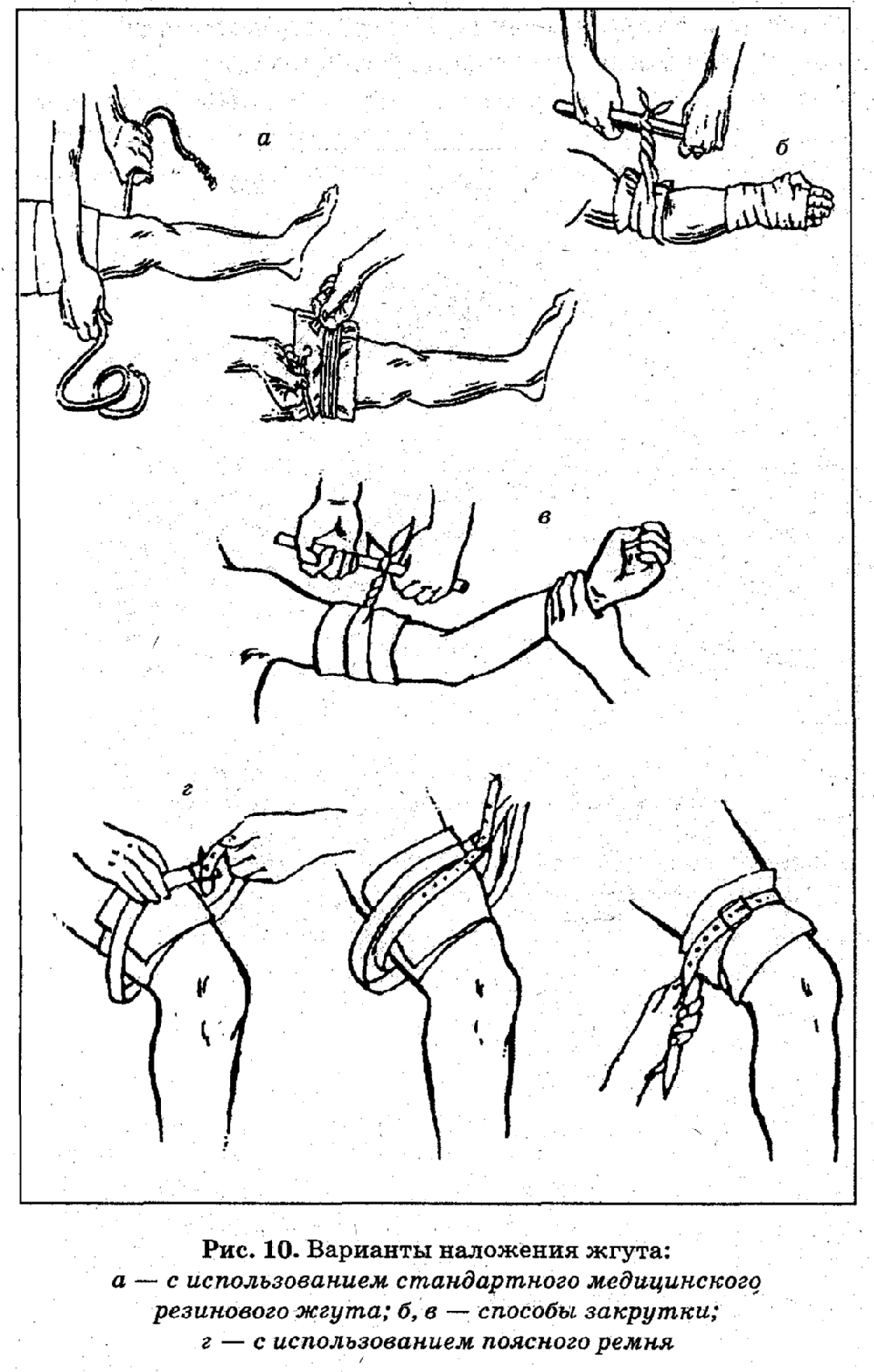 Как накладывать жгут. Остановка кровотечения наложение жгута алгоритм. Наложение жгута Эсмарха алгоритм. Наложение артериального жгута закрутки алгоритм. Методы наложения жгута Эсмарха.