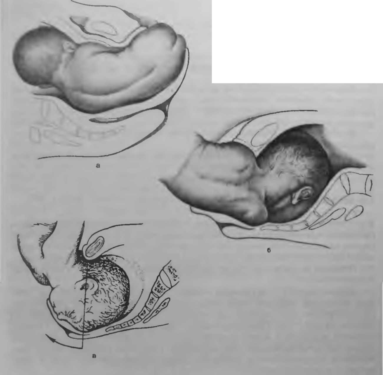 38 недель раскрытие. Положение ребенка в животе. Положение плода перед родами. Опускание головки плода. Предлежание ребенка в животе.