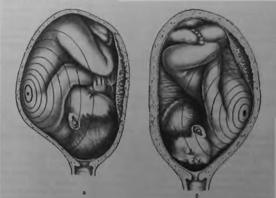 Ребенок расположен справа. Расположение ребенка в утробе. Положение ребенка в животе. Положение плода в утробе. Расположение ребенка в животе.