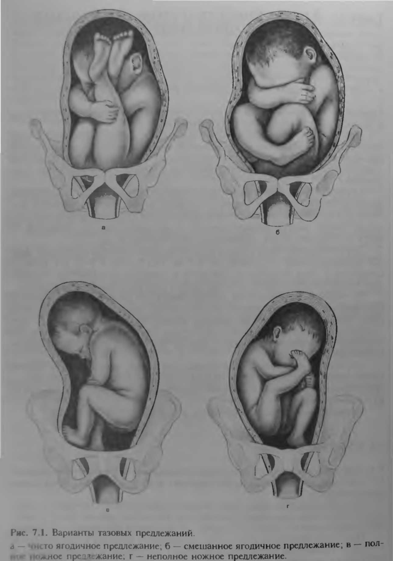 Ребенок расположен справа. Тазовое ножное предлежание плода. Предлежание плода 30. 29 Неделя беременности тазовое предлежание. Малыш в тазовом предлежании.