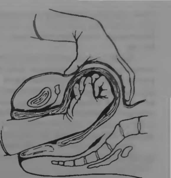 Массаж матки после родов. Наружный внутренний массаж матки.