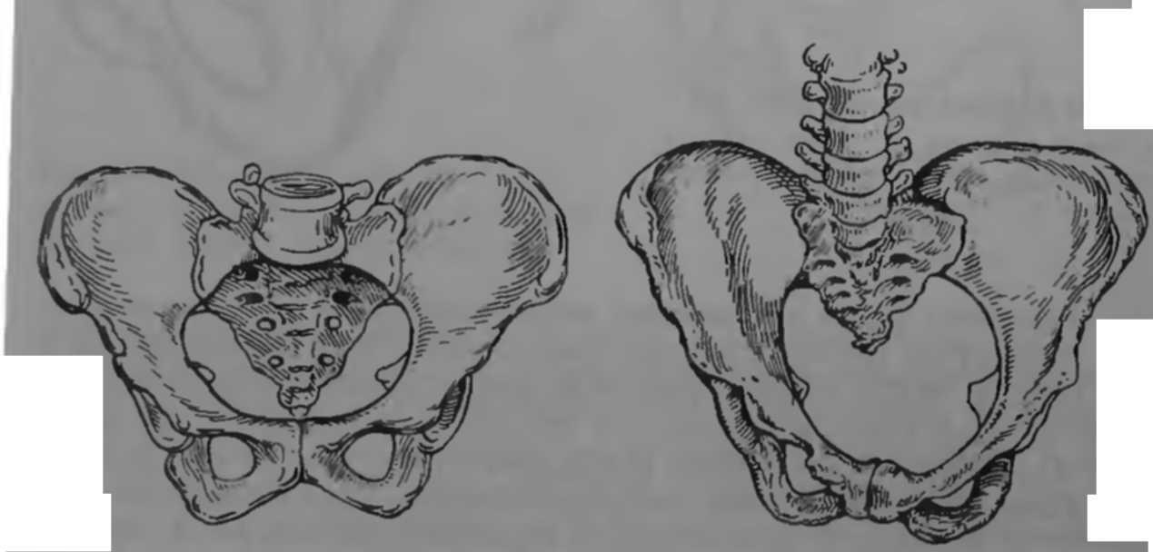 Изменения костей таза. Анатомический размер таза узкий и широкий. Кососуженный таз в акушерстве. Кососмещенный таз. Узкий и широкий женский таз.