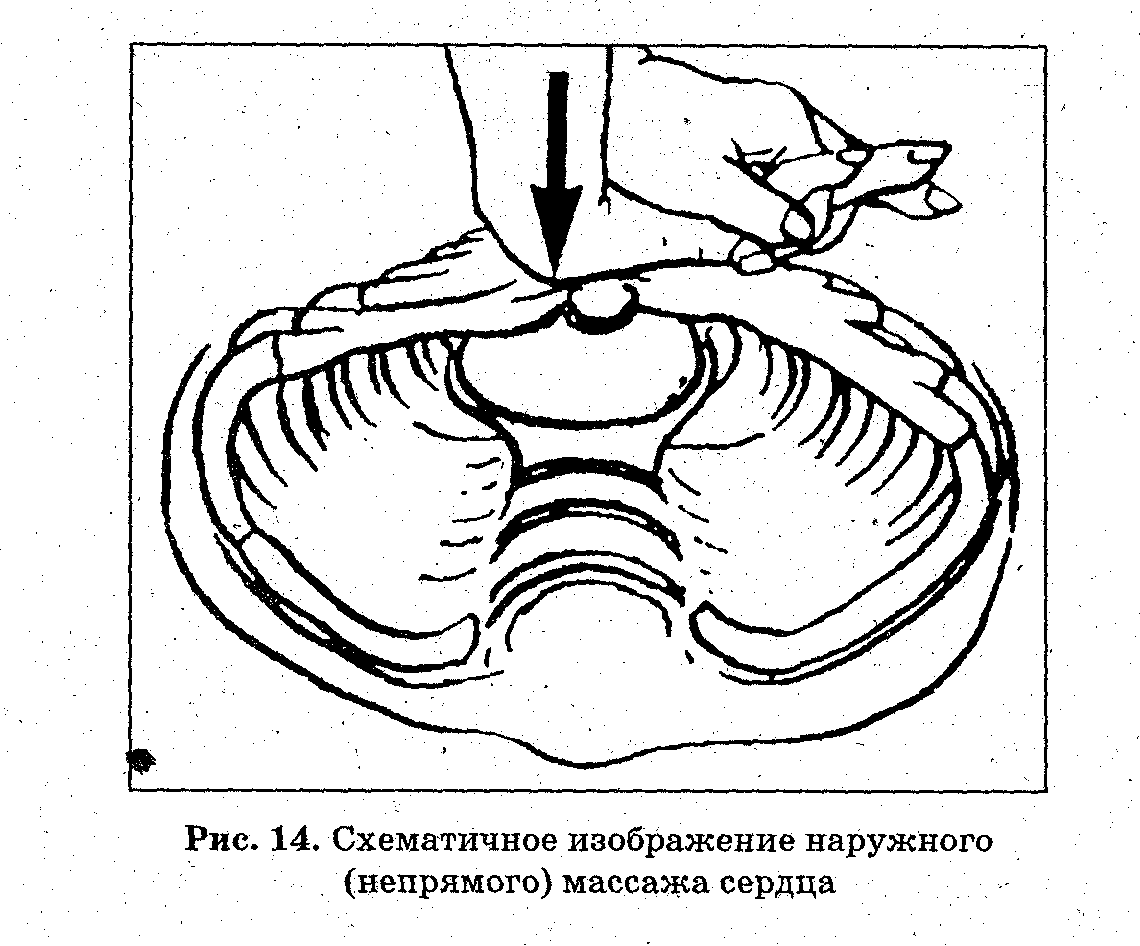 Непрямой массаж сердца презентация