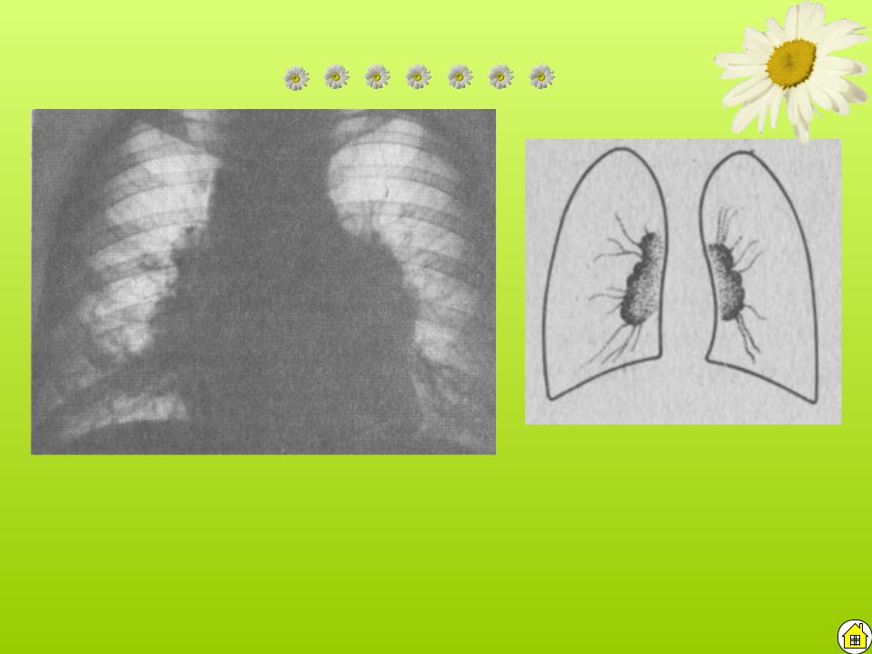 Корни легких усилены. Рентген уплотнение корня лёгкого. Увеличенные лимфатические узлы корня легкого рентген. Увеличение лимфатических узлов в корнях легких рентген.