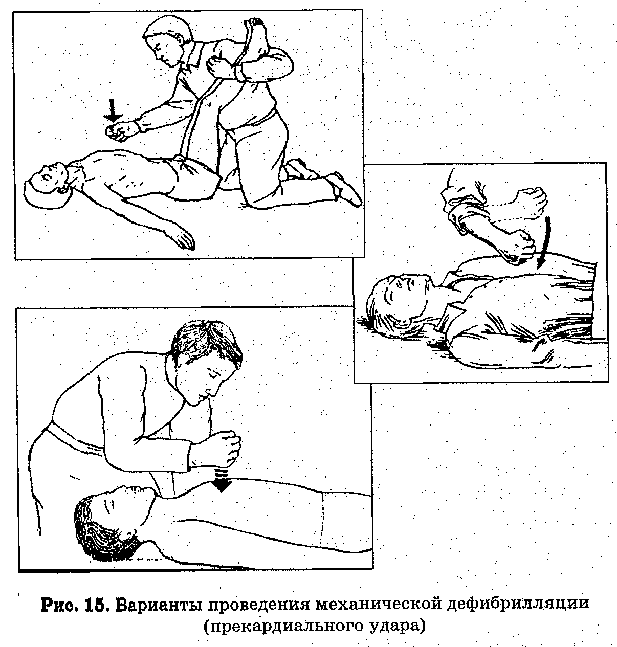 Помощь при ударе. Искусственное дыхание при поражении электрическим током. Массаж сердца при поражении электрическим током. Первая помощь при поражении электрическим током. Искусственное дыхание и непрямой массаж сердца при поражении током.