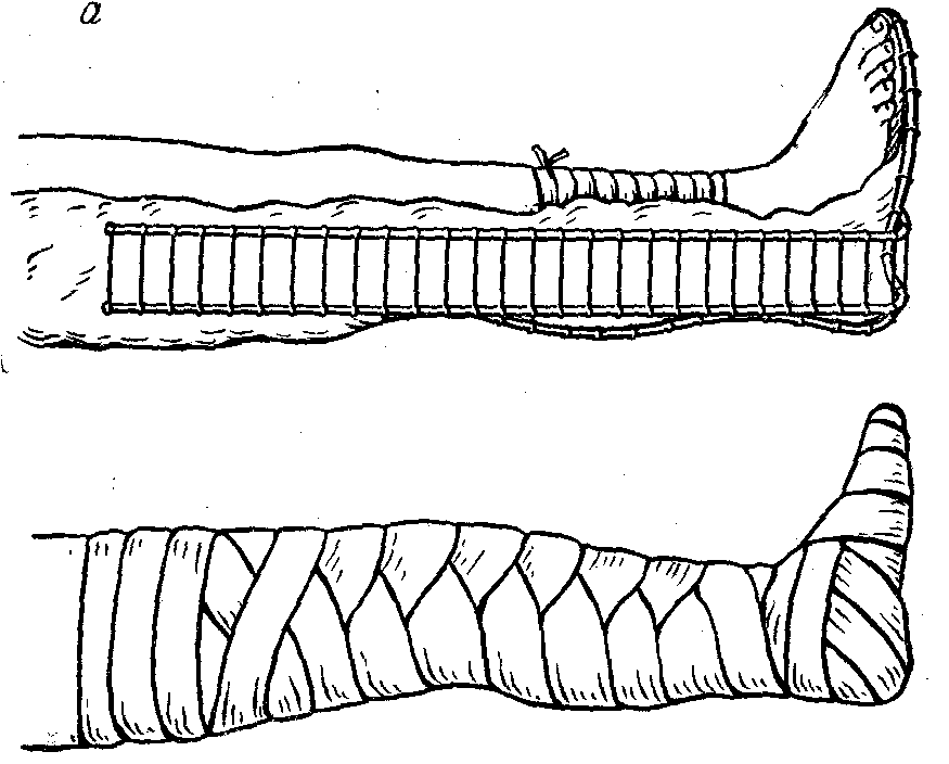 Транспортная иммобилизация нижней конечности. Шина Крамера перелом костей голени. Иммобилизация голени шиной Крамера. Иммобилизации костей голени шиной Крамера (на статисте)..