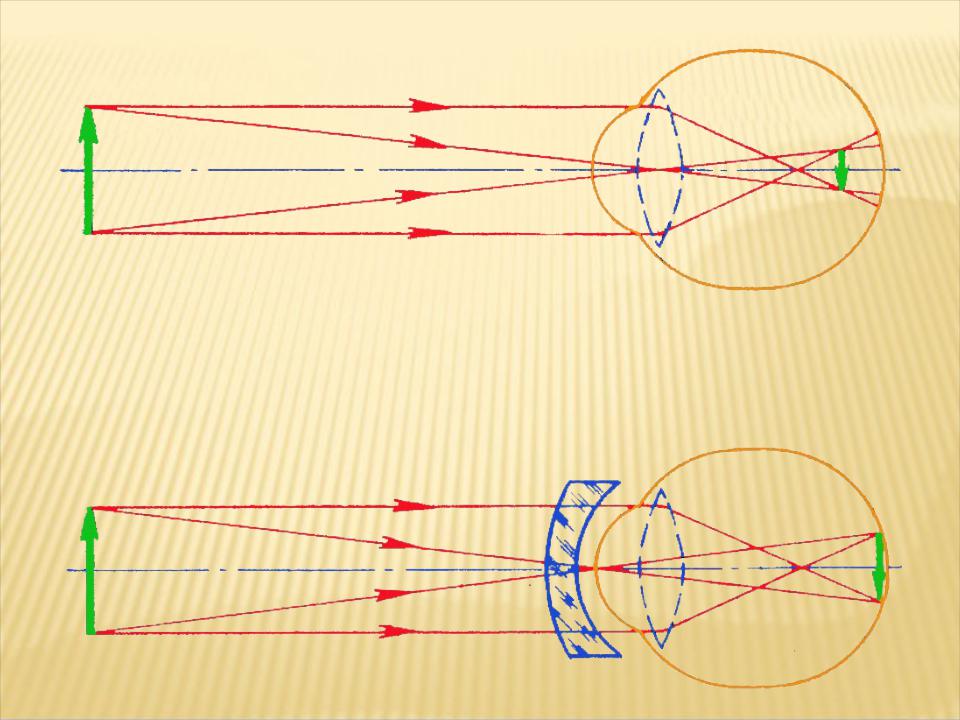 Схема хода лучей при дальнозоркости