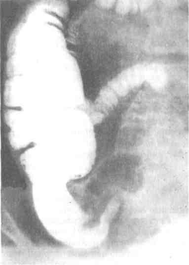 Мкб слепой кишки. Экзофитные опухоли толстой кишки. Нисходящей ободочной кишки рентген. Опухоль ободочной кишки рентген. Блюдцеобразная опухоль слепой кишки.