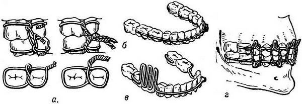 При переломе челюсти шинирование схема