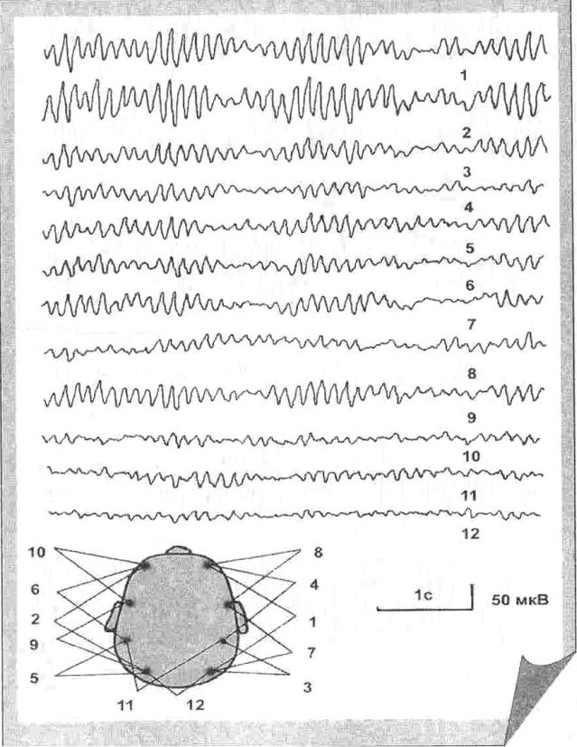 Показатели ээг. Гипервентиляция ЭЭГ норма. ЭЭГ мониторинг эпилепсия. Снимки ЭЭГ В норме. Норма МКВ на ЭЭГ.
